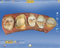 CEREC close-up at Reston Family Dental in Reston, VA