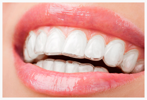 Invisalign Braces Reston VA