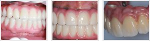 Implant Dentures Reston VA