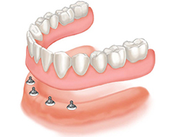 Snap-in Dentures Reston