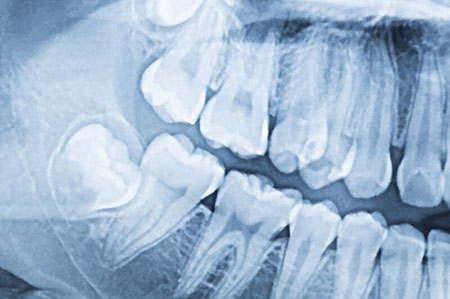 x-ray of wisdom teeth in Reston, VA