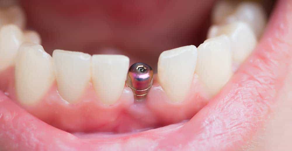 a person with a toothbrush in their mouth  at emergency dentist Reston in Reston, VA