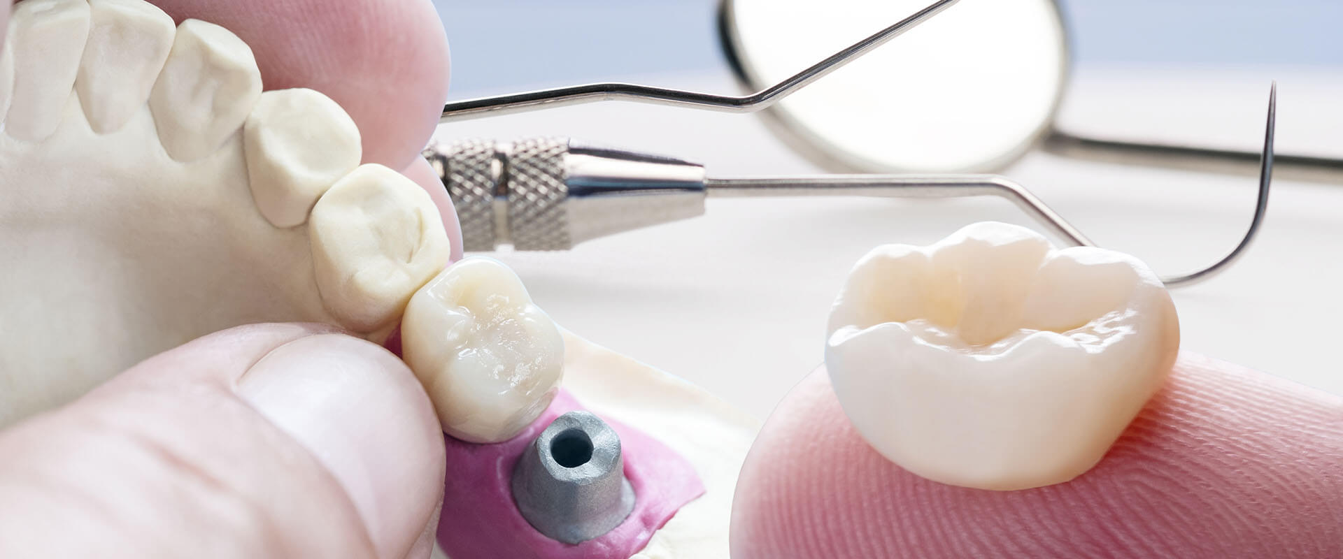 Hybrid Implant Denture - Reston Family Dental Center